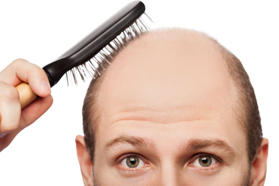 5 Tips for Men Who are Going Bald